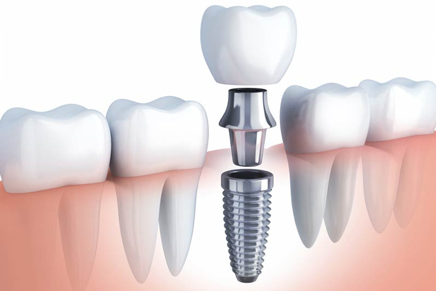 Dental Implants in Spring